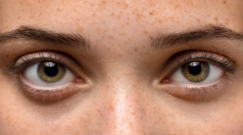 Dark Eye Circles treatment and casuese